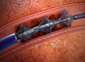 Huntington Hospital Uses Cutting-Edge FlowTriever® Device for Safe and Effective Treatment of Pulmonary Embolism