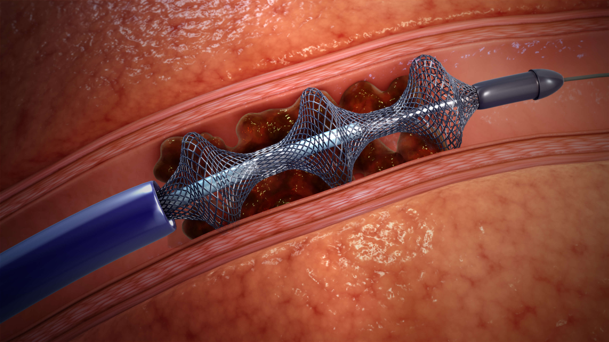 Huntington Hospital Uses Cutting-Edge FlowTriever® Device for Safe and Effective Treatment of Pulmonary Embolism