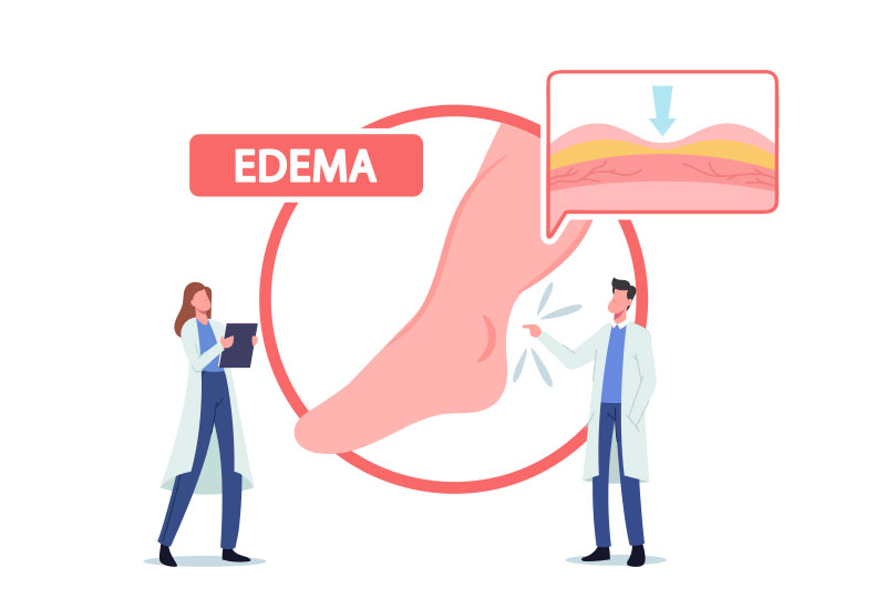 illustration: All about lymphedema