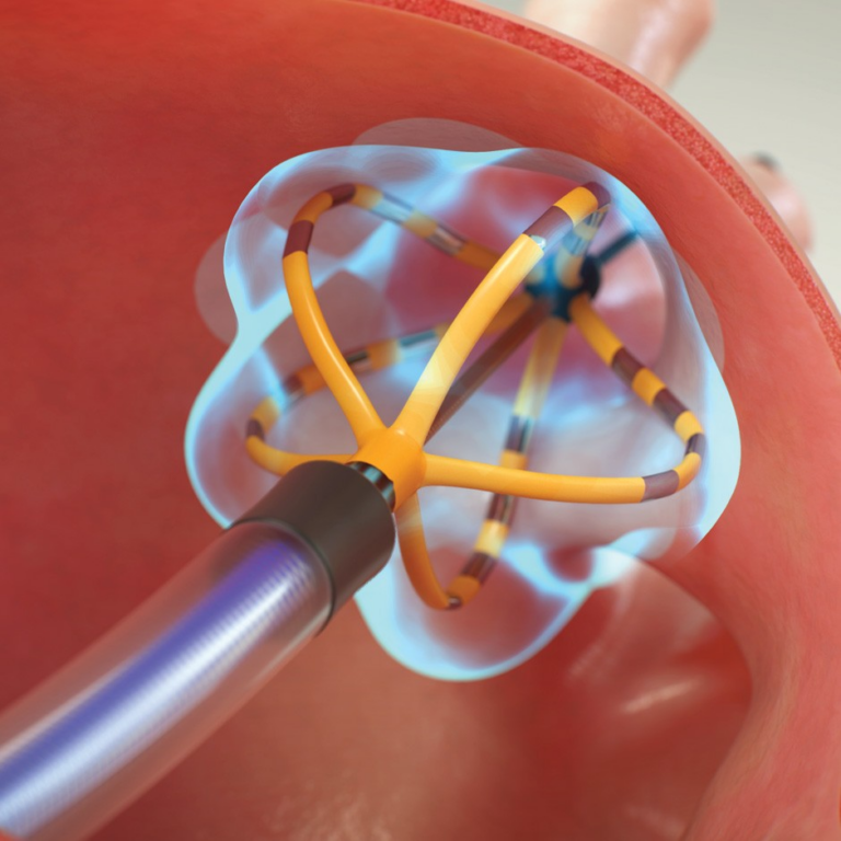 Medical illustration of catheter device inside a blood vessel
