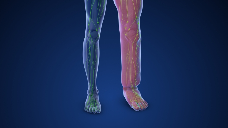 Medical,Animation,Depicting,Limb,Lymphedema,3d,Illustration